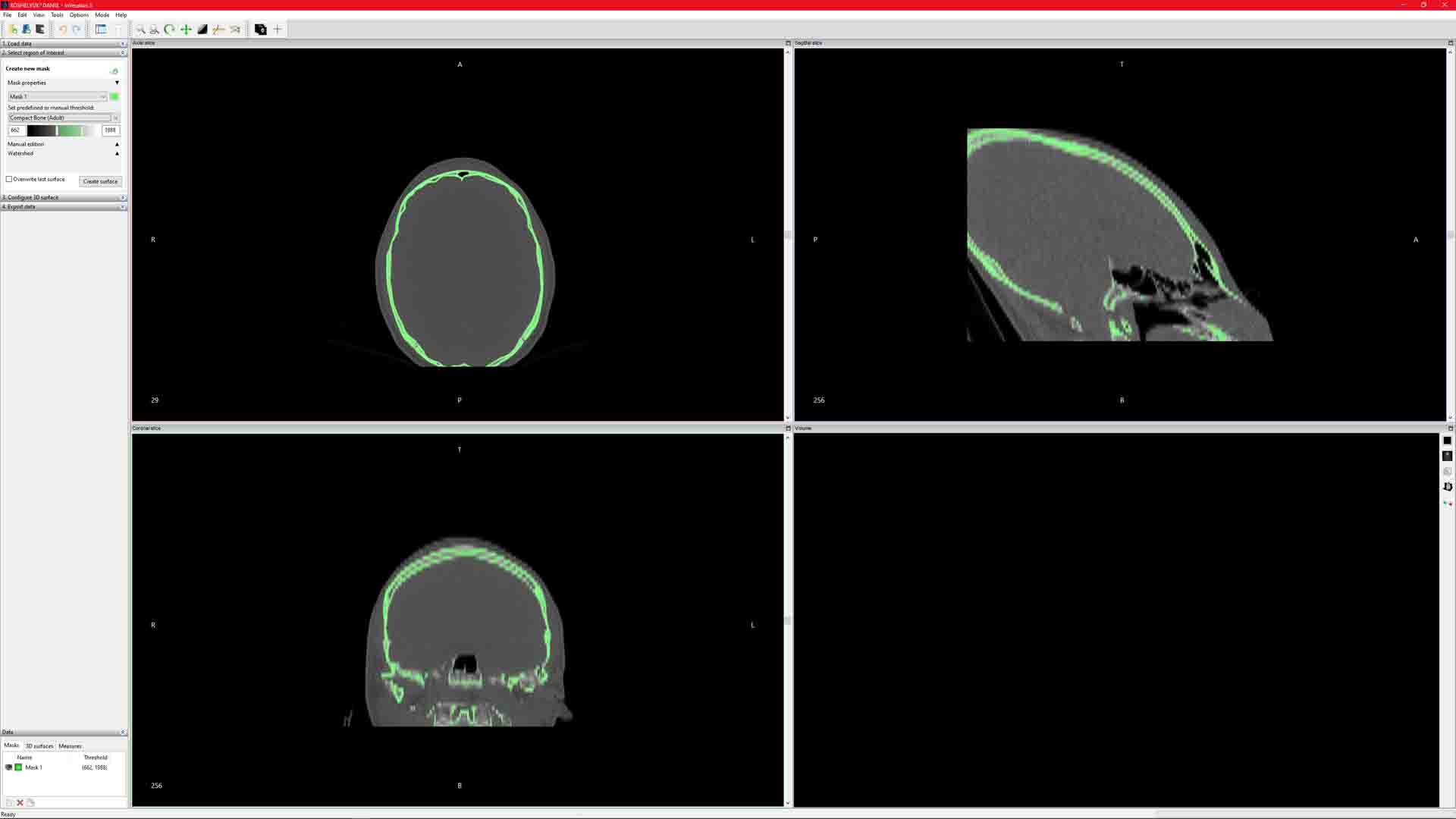 MRI